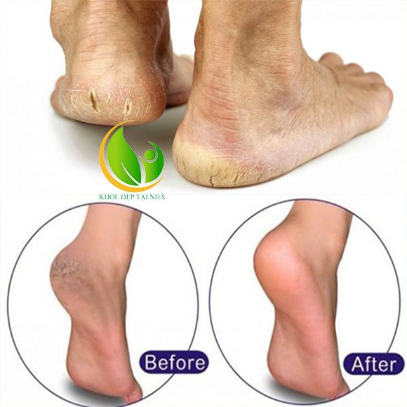 Nứt gót chân không chỉ gây đau đớn, bất tiện mà còn mất thẩm mỹ kể cả ở nam và nữ
